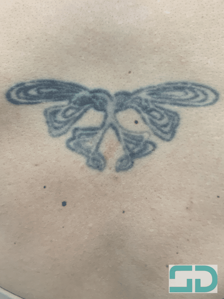 Before Image: Tattoo Removal - back