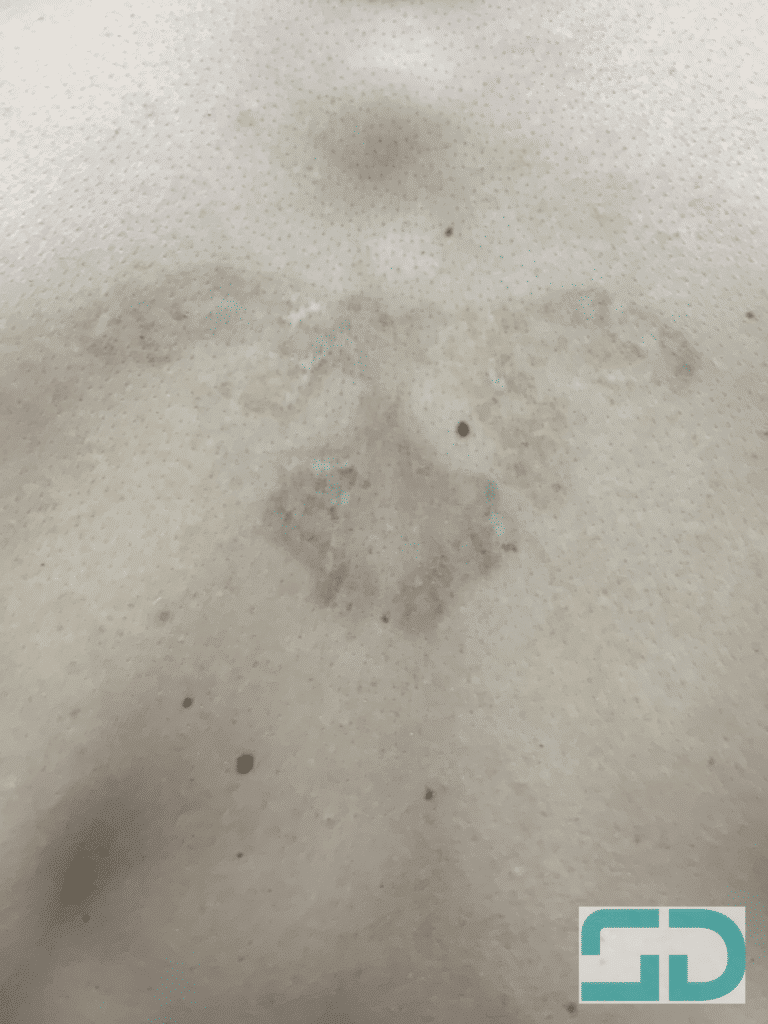 After Image: Tattoo Removal - back