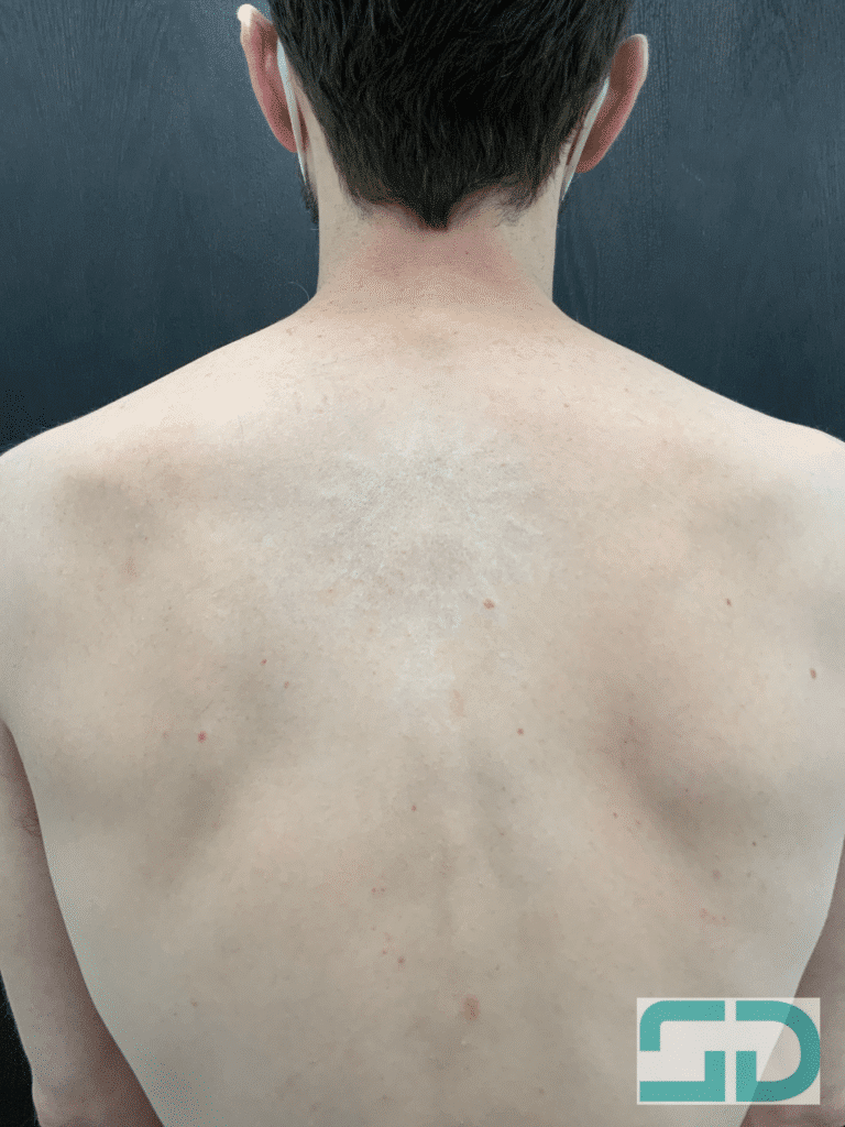 After Image: Tattoo Removal - back